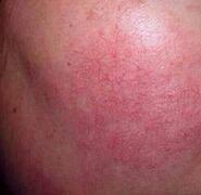 激素依赖性皮炎是怎样一种皮肤病?