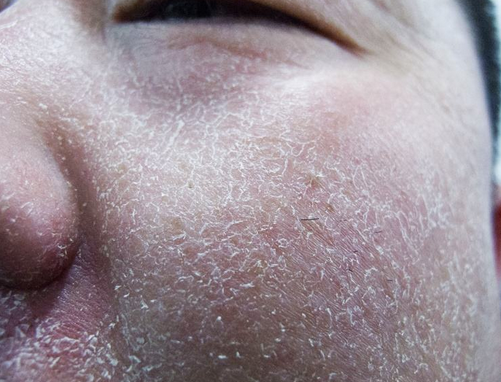 激素脸蜕皮脱屑是康复的表现吗？
