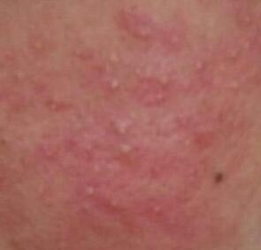 脸发红、干痒，是湿疹还是激素脸？