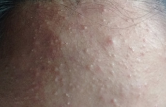 秋冬季节，激素依赖性皮炎如何护理皮肤不干燥？