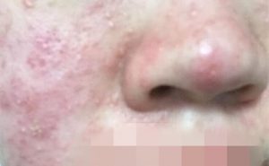 脸部反复红痒、脱皮，都是同一个位置，抹药膏好了，过几天又犯，是激素脸吗?