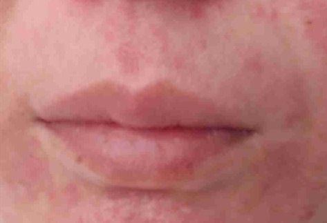 下巴、嘴角周围冒痘，是激素依赖性皮炎的症状吗？