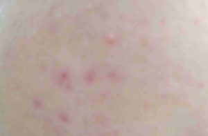 早晨起来突然长了好多痘痘，为什么啊?是激素依赖性皮炎吗?