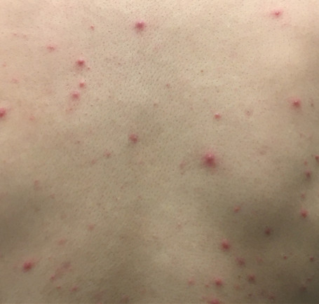 激素依赖性皮炎研究院：冬季洗澡过勤易导致湿疹“上身”，该怎么办?